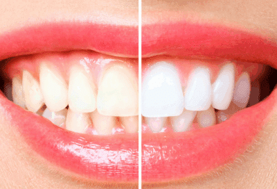 a close-up of a woman's teeth, showing the difference of whiteness on one side vs the other with professional teeth whitening