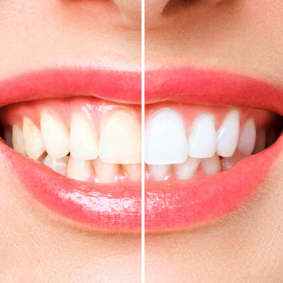 a close-up of a woman's teeth, showing the difference of whiteness on one side vs the other with professional teeth whitening