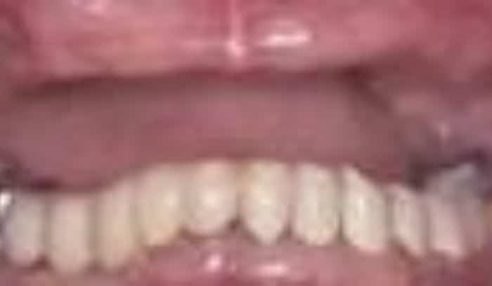 patient four before smile gallery lansdowne dentistry by design