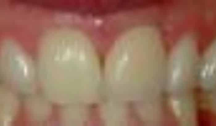 patient three after smile gallery lansdowne dentistry by design