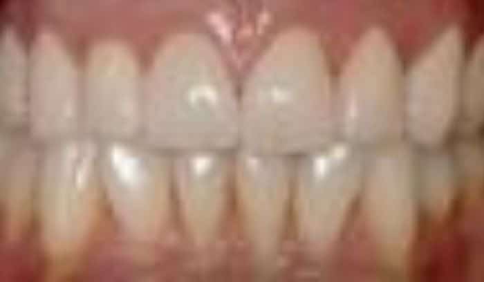 patient two after smile gallery lansdowne dentistry by design