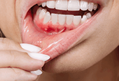 a close up of a person's mouth with lip being pulled down to show red gums, representing how to prevent gum disease