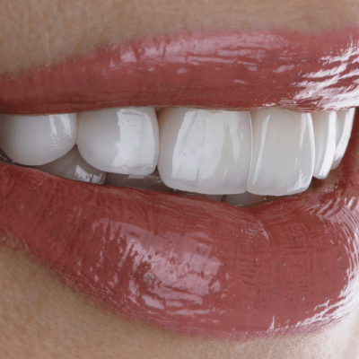 Close-up of glossy, white teeth, representing benefits of porcelain veneers