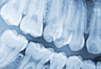 Dental X-ray showing teeth and roots, representing modern family dentistry